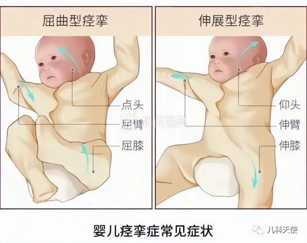 什么是第三代助孕宝宝痉挛